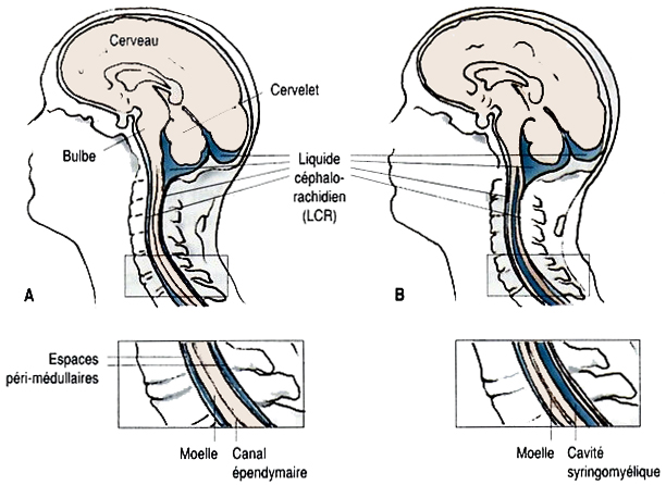 La syringomyélie | Spina-Bifida.org