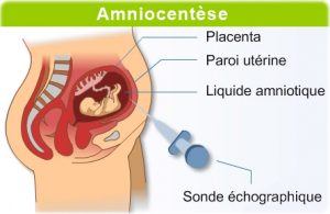 Amniocentese.jpg